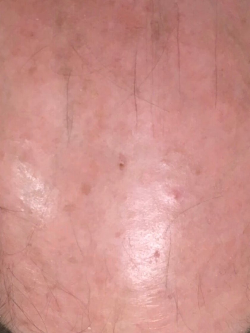 Anti-Aging Laser Treatment After