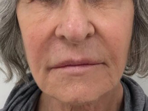 Smile Lines Treatment Before