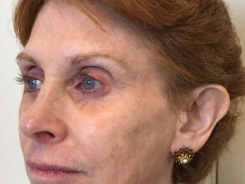 Mid and Lower Face Filler Before