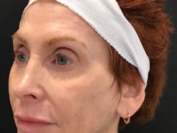 Mid and Lower Face Filler After