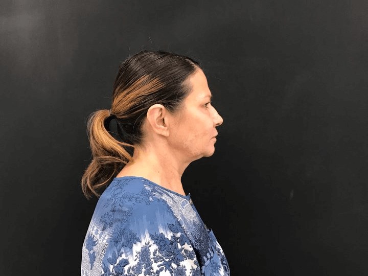 Neck adipose reduction Before