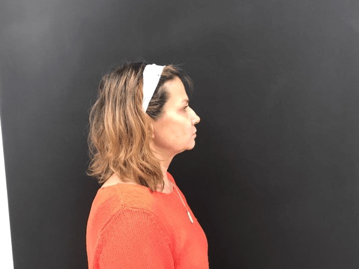 Neck adipose reduction After