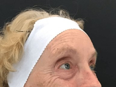 Crows Feet Treatment Before