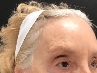 Crows Feet Treatment After