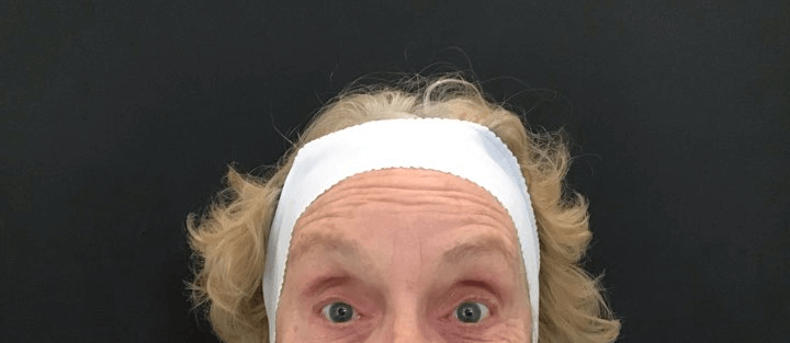 Crows Feet Treatment Before