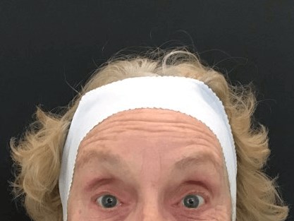 Crows Feet Treatment Before