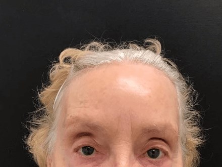 Crows Feet Treatment After