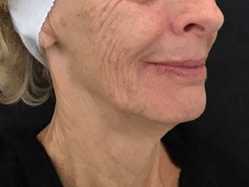 Lower Face Filler Before