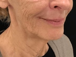 Lower Face Filler After