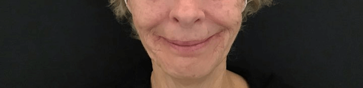 Lower Face Filler Before