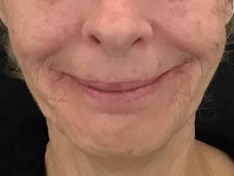 Lower Face Filler Before