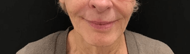 Lower Face Filler After