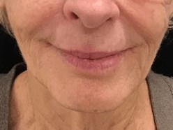 Lower Face Filler After