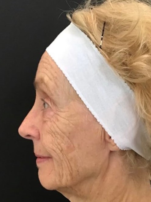 Smile Line Correction Before