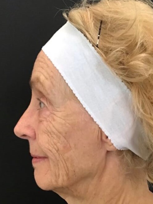 Smile Line Correction Before