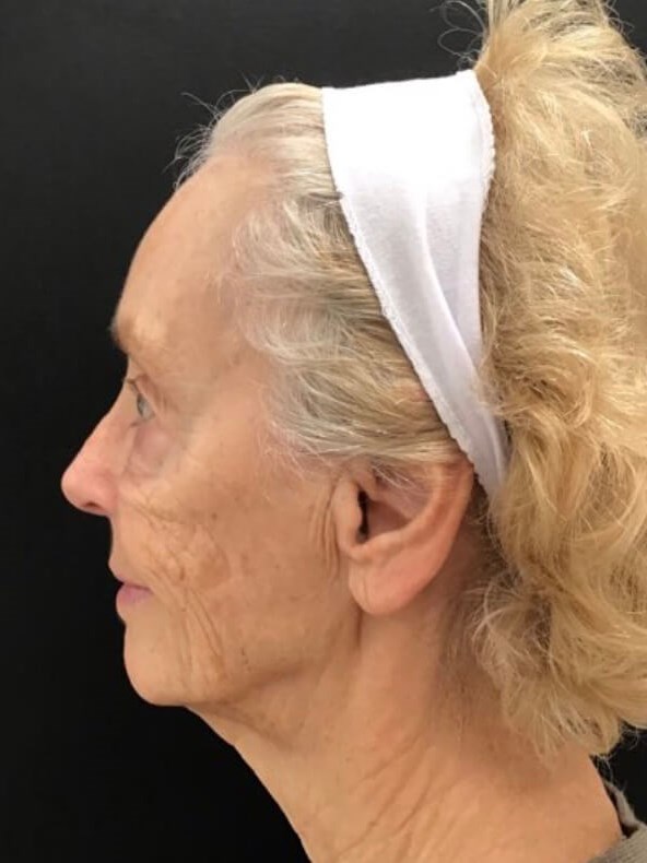 Smile Line Correction After