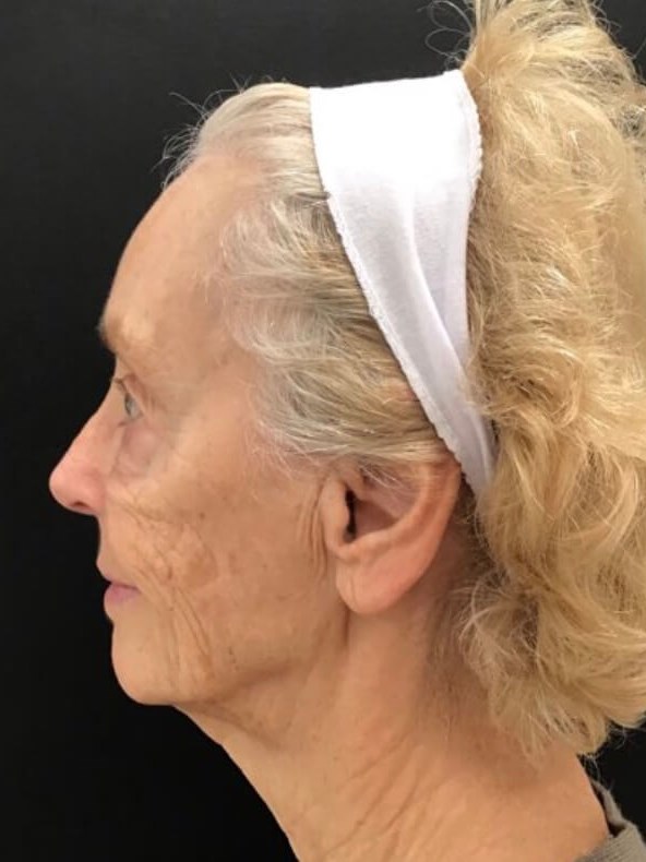 Smile Line Correction After