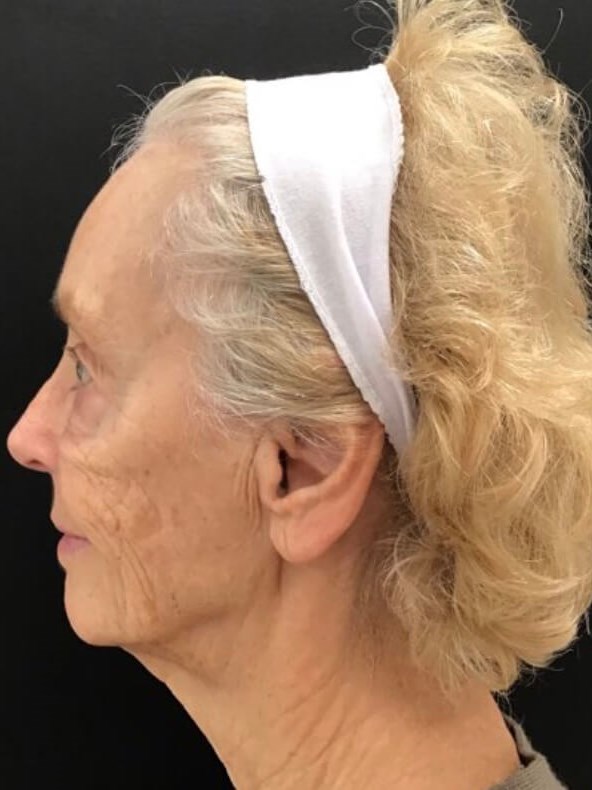 Smile Line Correction After