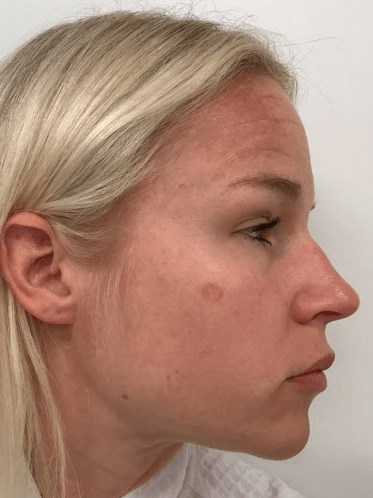 Melasma Before