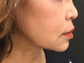 Cheek and Lip Enhancement After