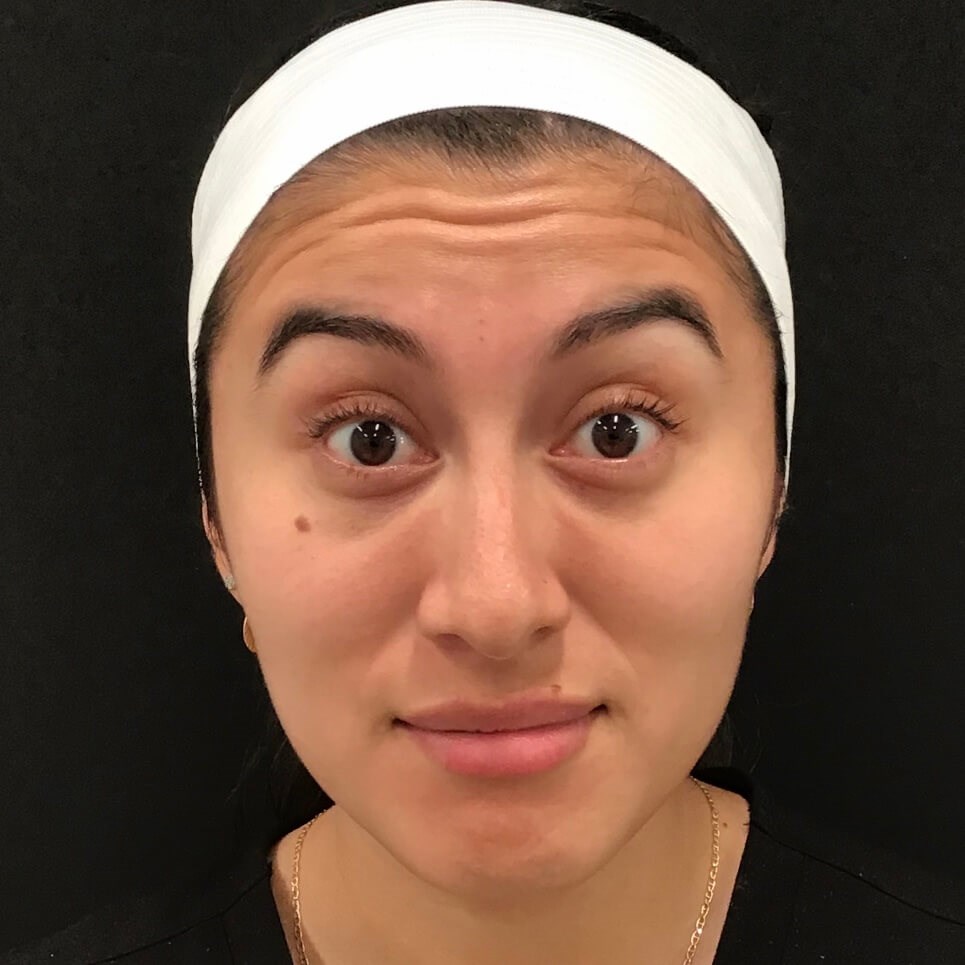 Forehead Treatment Before