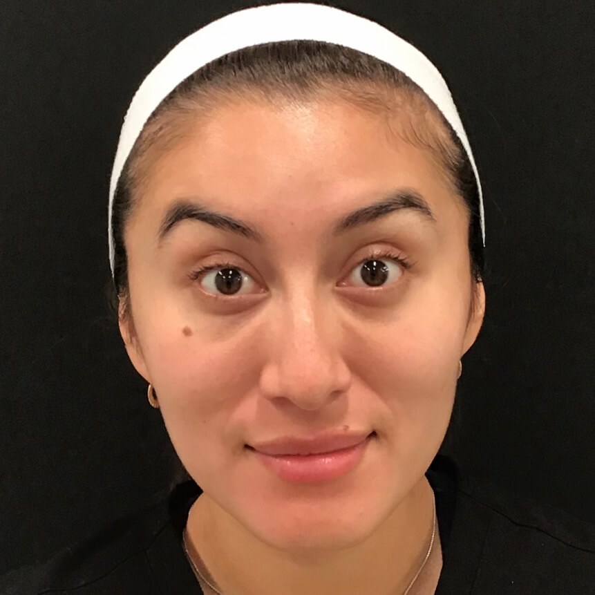 Forehead Treatment After