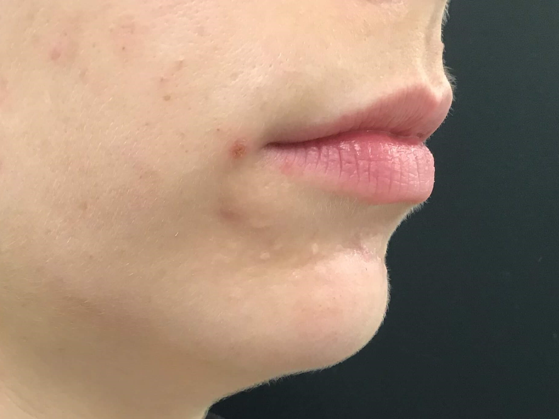 Beautiful Lip Augmentation Before