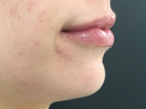 Beautiful Lip Augmentation After