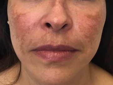 Hyperpigmenation Removal Before