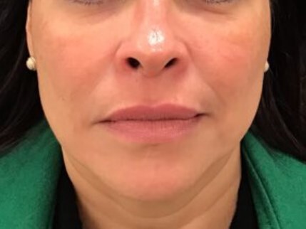 Hyperpigmenation Removal After