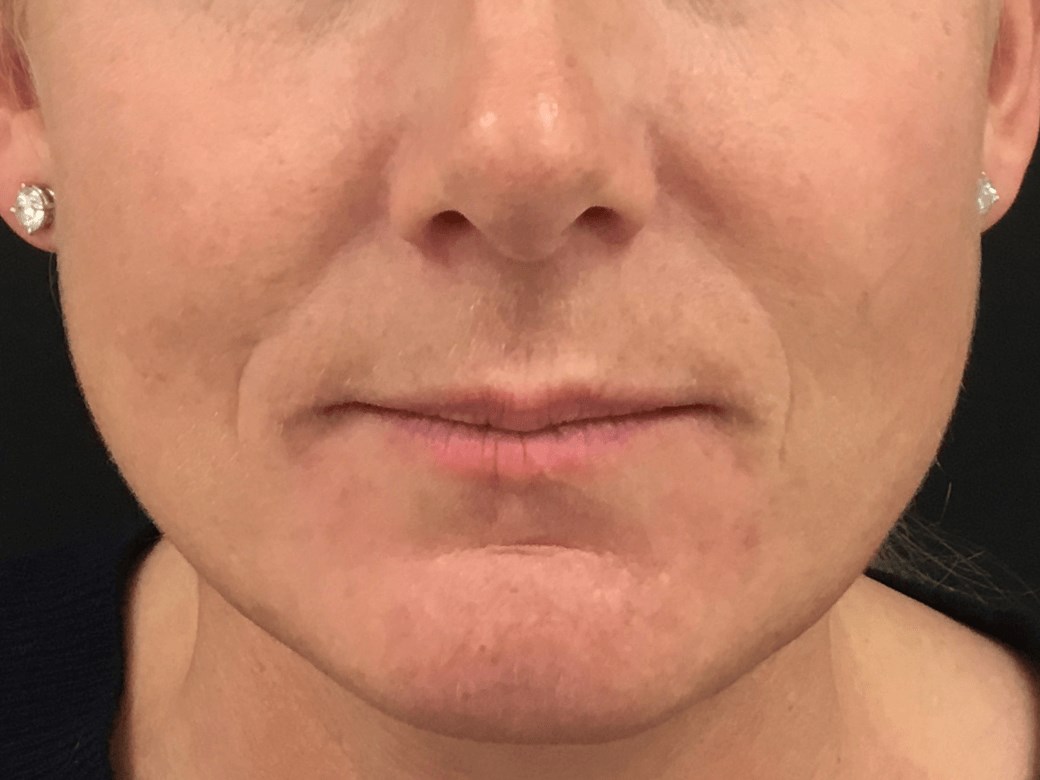 Reduce Smile Lines Before