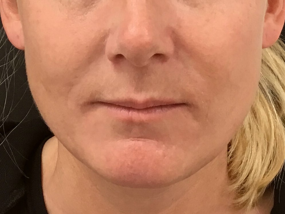 Reduce Smile Lines After