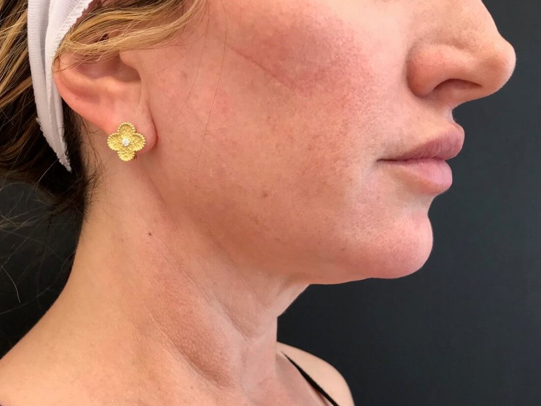 Thread Lift & Filler Before Threads &chin filler