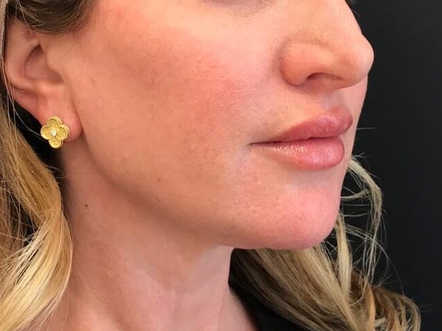 Thread Lift & Filler After treatment