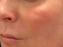 Define Cheeks - Left Side Before