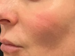 Define Cheeks - Left Side After