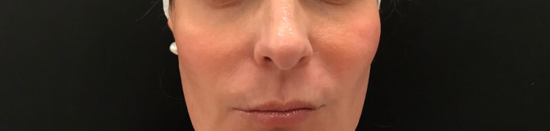 Define Cheeks - Front View Before