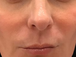 Define Cheeks - Front View Before