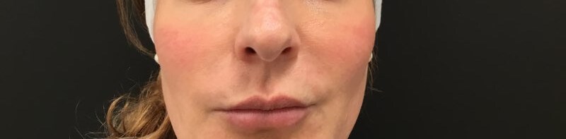 Define Cheeks - Front View After