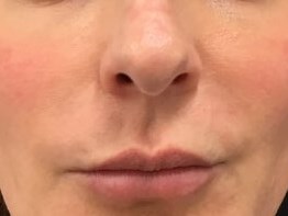 Define Cheeks - Front View After