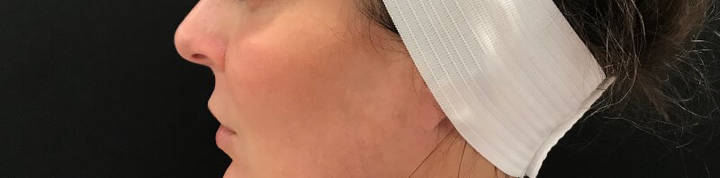 Define Cheeks - Profile View Before