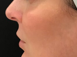 Define Cheeks - Profile View Before