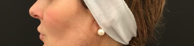 Define Cheeks - Profile View After