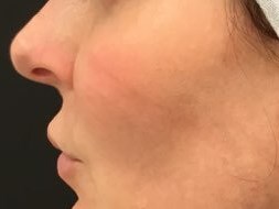 Define Cheeks - Profile View After