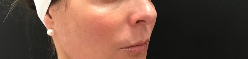 Define Cheeks - Right Side Before