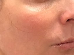 Define Cheeks - Right Side Before