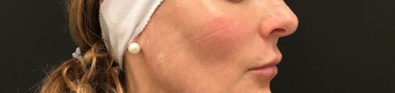 Define Cheeks - Right Side After