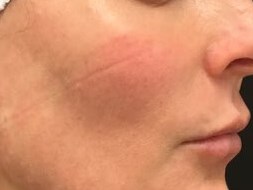 Define Cheeks - Right Side After