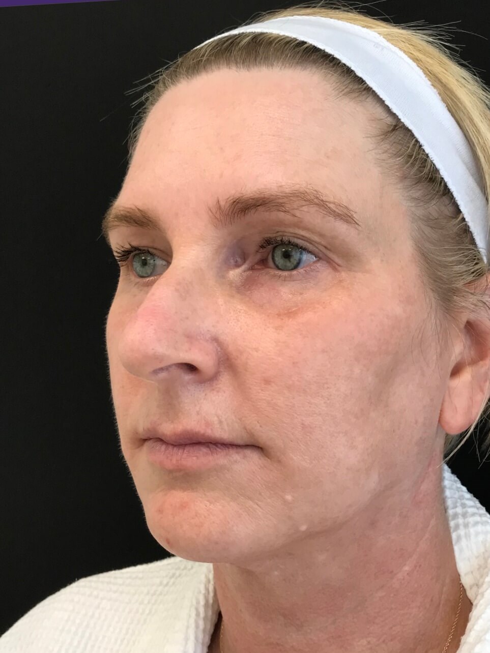 Mid and lower face treatment Before