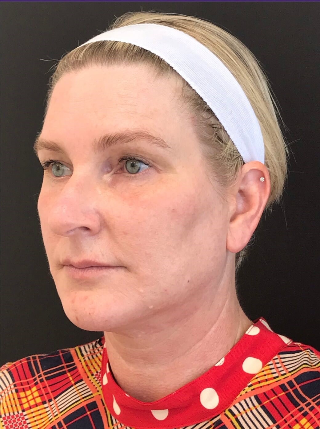 Mid and lower face treatment After